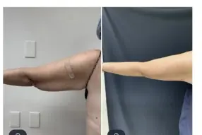 Before and after arm liposuction by Dr.Drew Varano in Washington DC